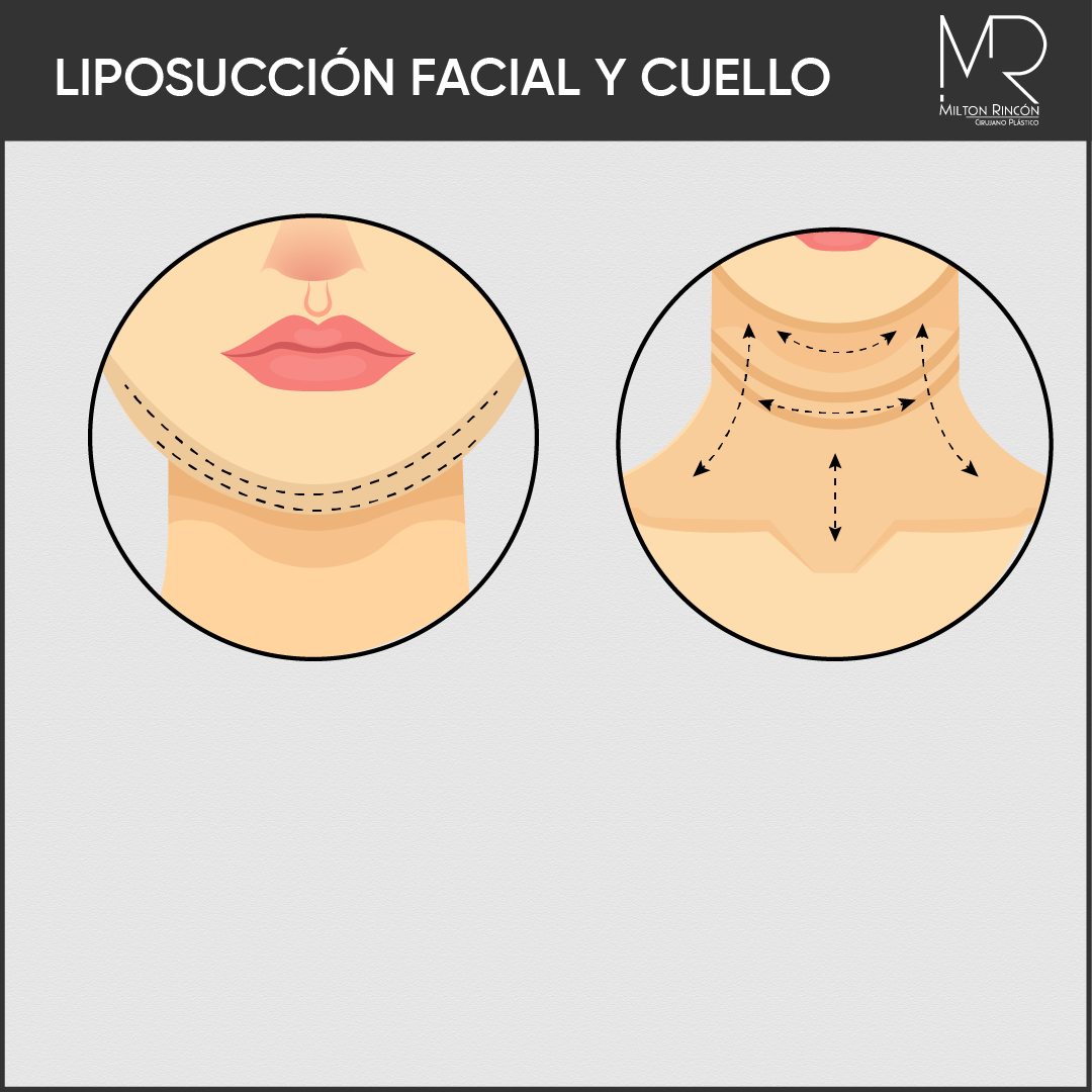 Evolución de abdominoplastia